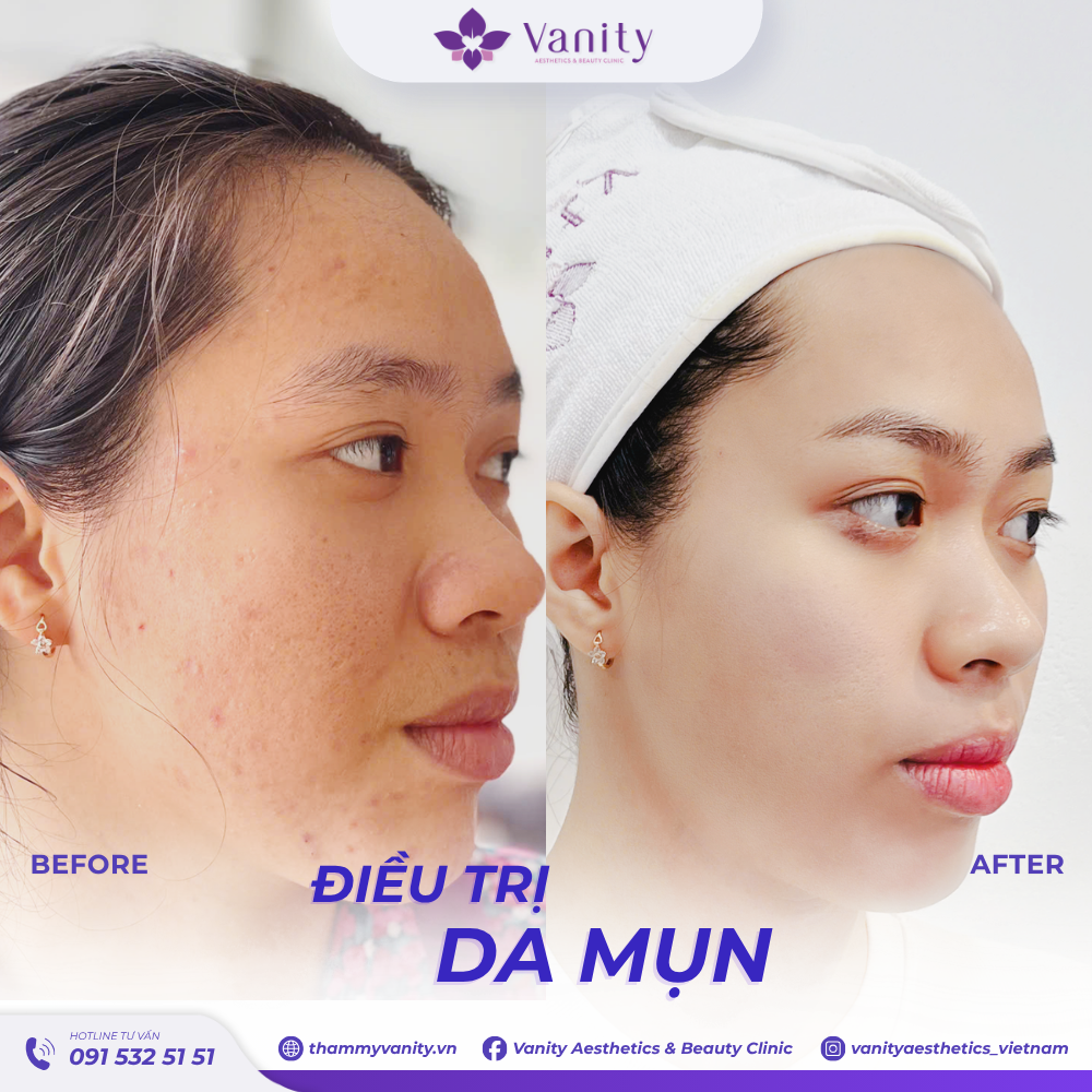 ĐIỀU TRỊ DA MỤN